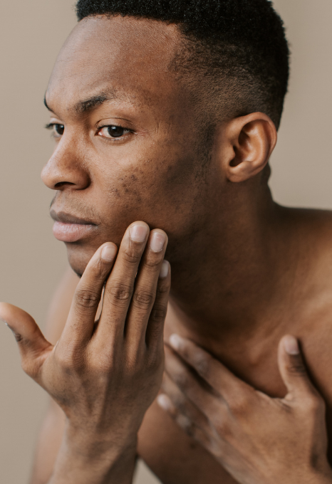 Poils incarnés sur peau noire : routine avant et après épilation